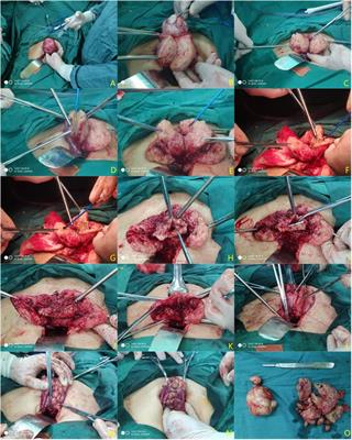 Application of modified subtotal resection of adenomyosis combined with LNG-IUS and GnRH-a sequential therapy in severe adenomyosis: A case series